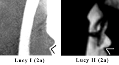 Profile Photographs of the Real Sister Lucia and the fake Sister Lucy - closeup of their noses